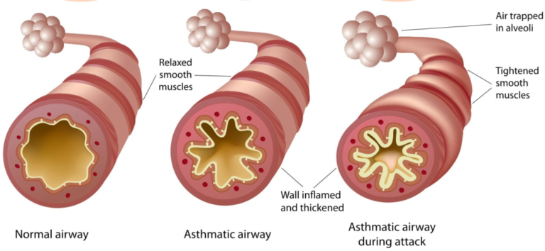 Controlling Asthma Attacks: Breathing and Relaxation